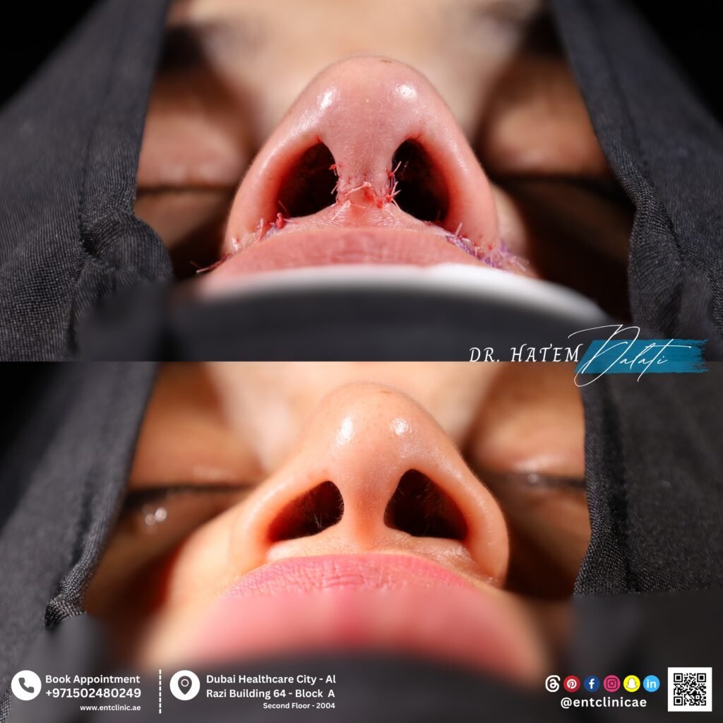 هل يمكن لتجميل الأنف تصحيح عدم تساوي فتحات الأنف في دبي؟ دليل شامل للمرضى هل يمكن لتجميل الأنف تصحيح عدم تساوي فتحات الأنف في دبي؟ دليل شامل للمرضى