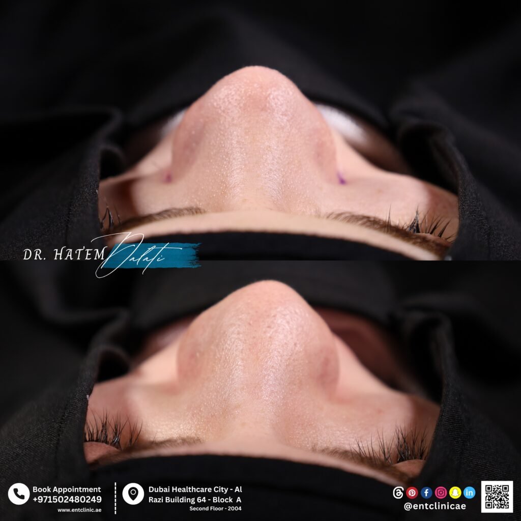 من زاوية القاعدة قبل وبعد عملية تصحيح الحاجز الأنفي مع تجميل الأنف، مع إبراز تحسن تناسق فتحات الأنف وتوازن بنية طرف الأنف.