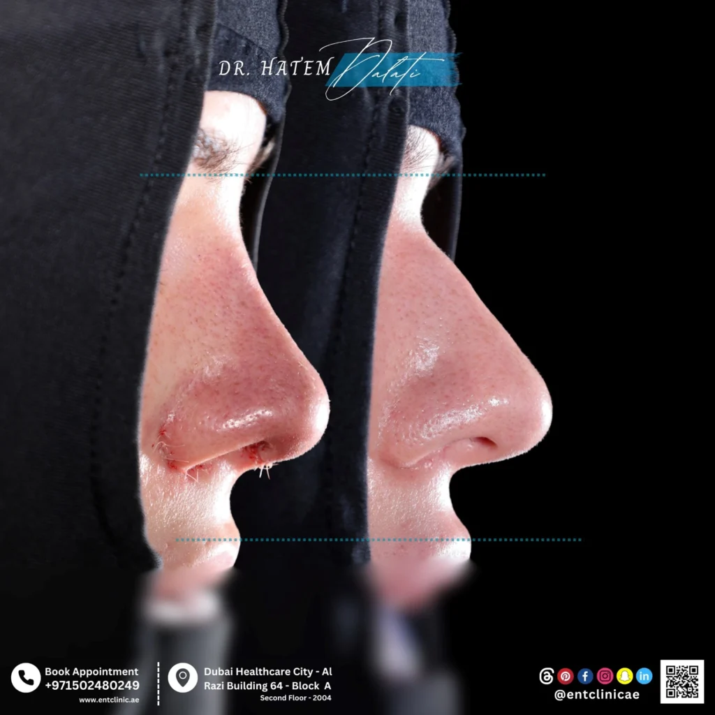 هل عملية تجميل الأنف مؤلمة؟ ما الذي يمكن أن تتوقعه قبل وبعد جراحة الأنف في دبي