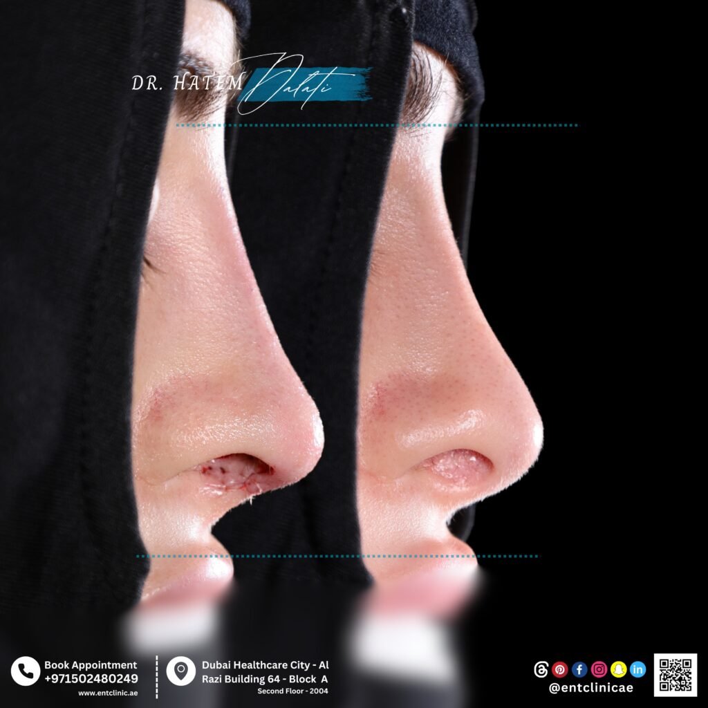 Revision rhinoplasty before and after results correcting previous nose surgery in Dubai