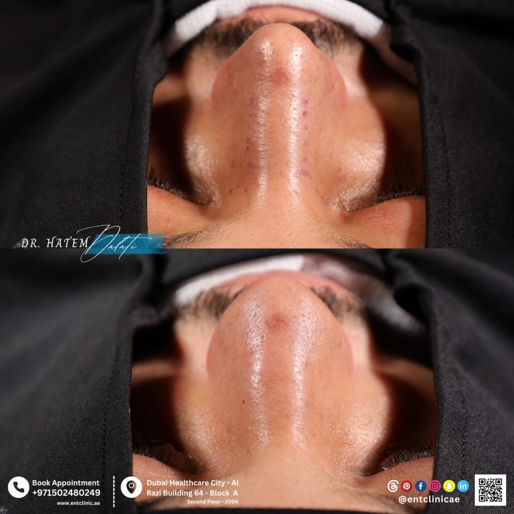 Male septorhinoplasty base view before and after showing improved nostril symmetry and nasal tip support