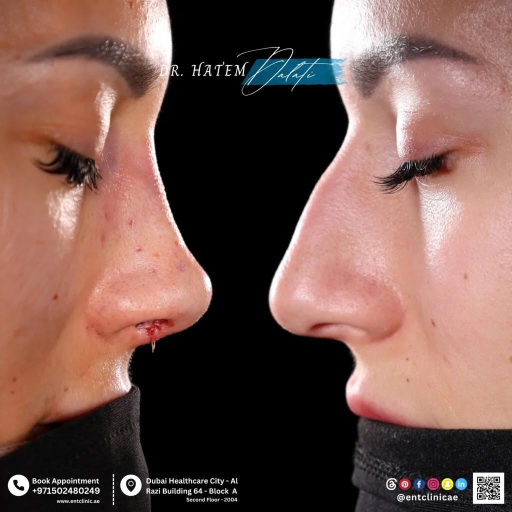 أي شكل أنف يناسب وجهي أكثر؟تصحيح الأنف الروماني مع إزالة تحدّب جسر الأنف وتحسين المظهر الجانبي.