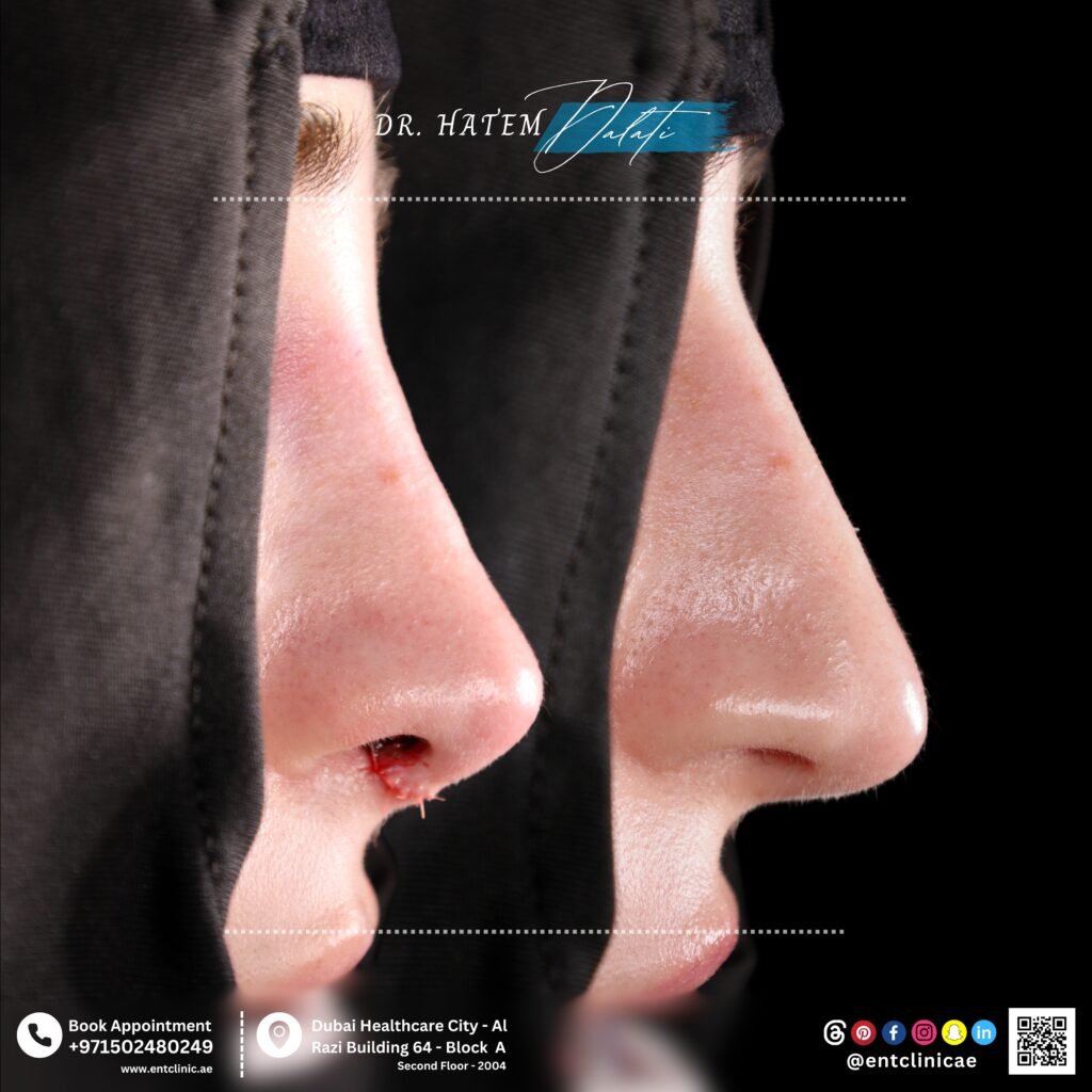 What Is Nasal Valve Collapse and Can Rhinoplasty Fix It?