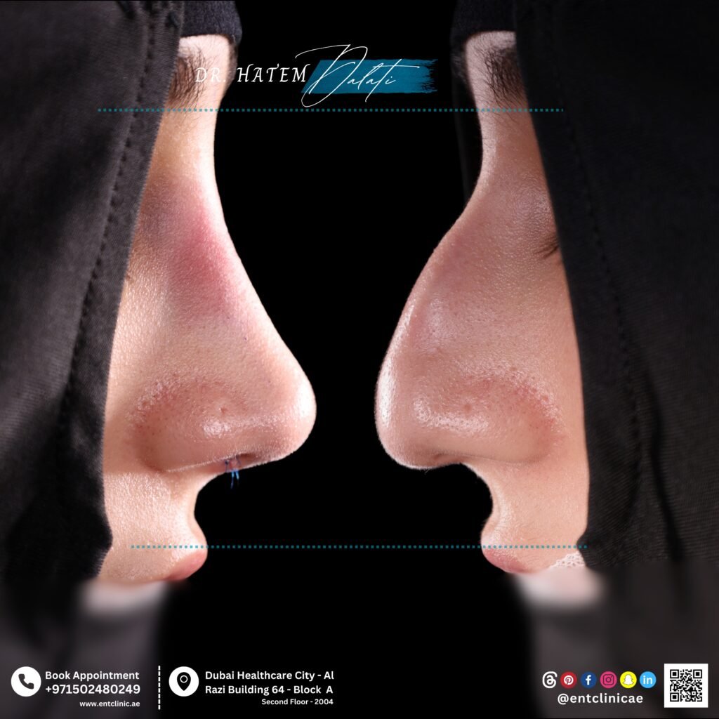Had Rhinoplasty Outside the UAE? Your Complete Post-Surgery Follow-Up Guide in Dubai
