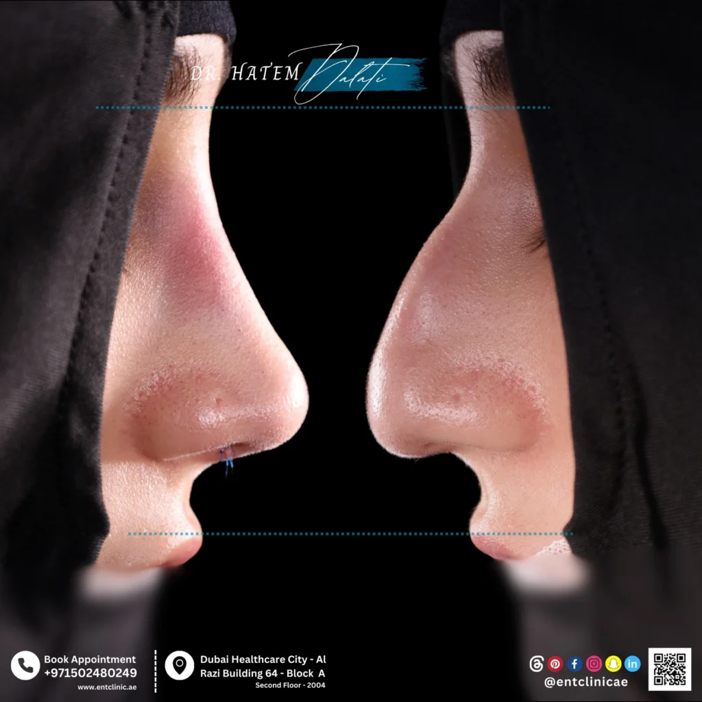 Cast and Splint Removal After Rhinoplasty in Dubai: Safe Post-Operative Care for Patients Abroad Cast and Splint Removal After Rhinoplasty in Dubai: Safe Post-Operative Care for Patients Abroad