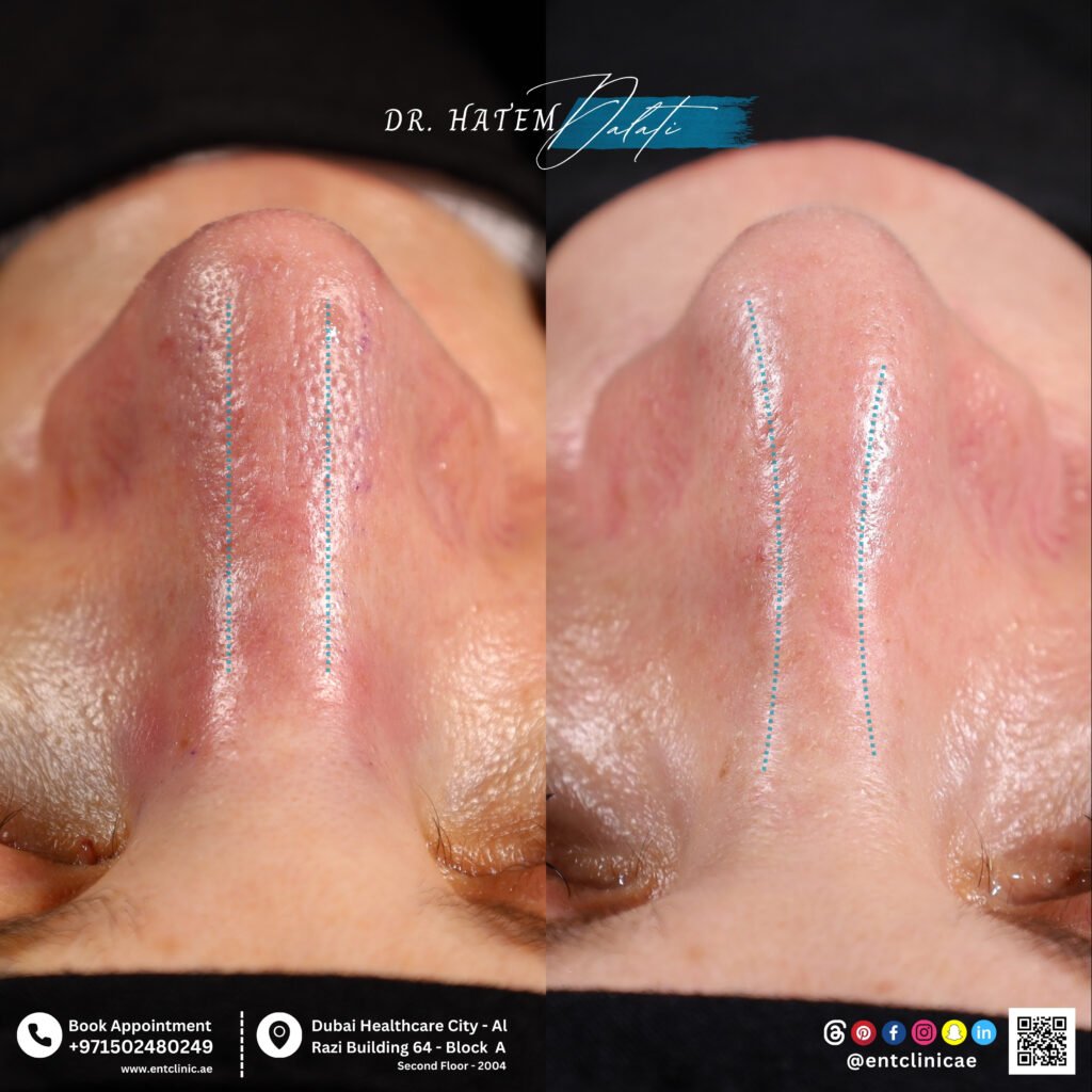 basal view showing improved septal alignment after revision rhinoplasty Dubai