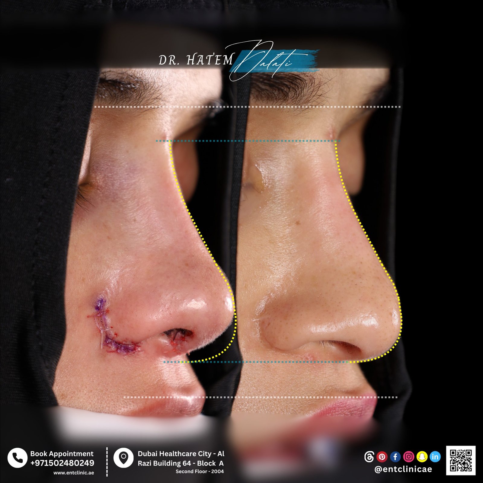 Revision rhinoplasty for Middle Eastern thick-skin anatomy by Dr. Hatem Dalati, preserving ethnic identity and nasal tip definition.