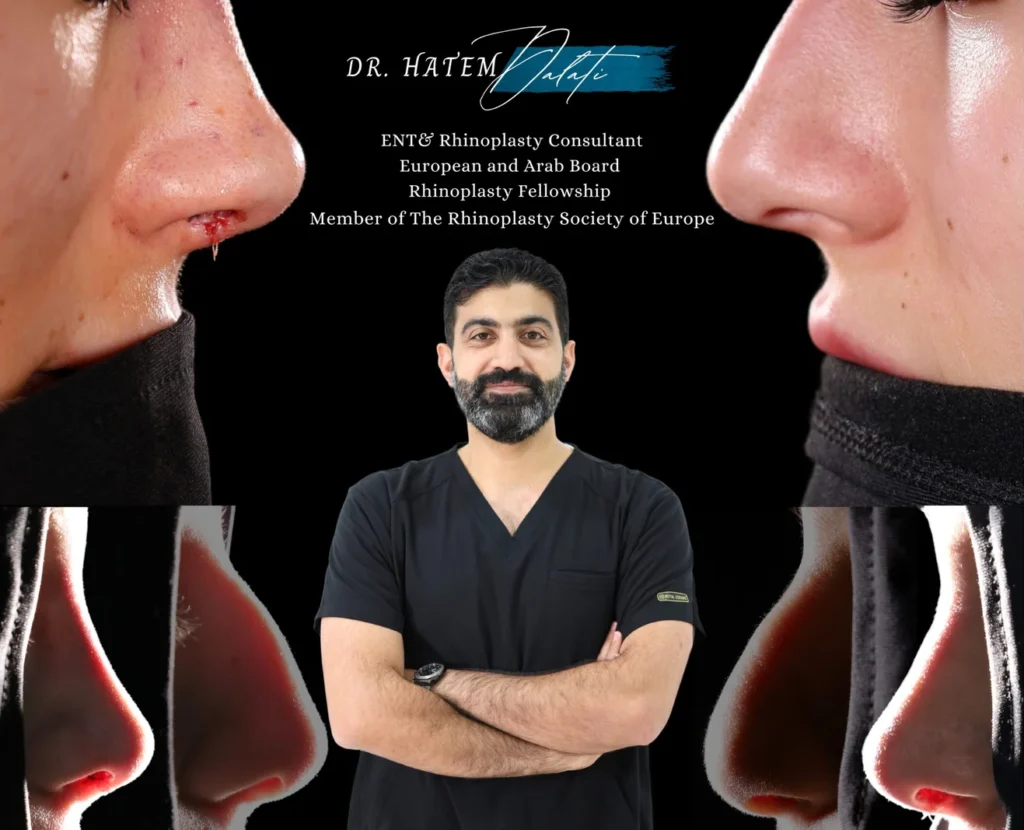 Famous Arab Celebrities Who Had Nose Jobs 👃✨ | Insights from Dubai’s Top ENT & Rhinoplasty Surgeon