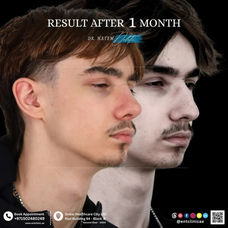 RHINOPLASTY-DR-HATEM-DALATI-DUBAI-ENT-CONSULTANT-ENT-CLINIC-OF-EXCELLENCE rhino (1)