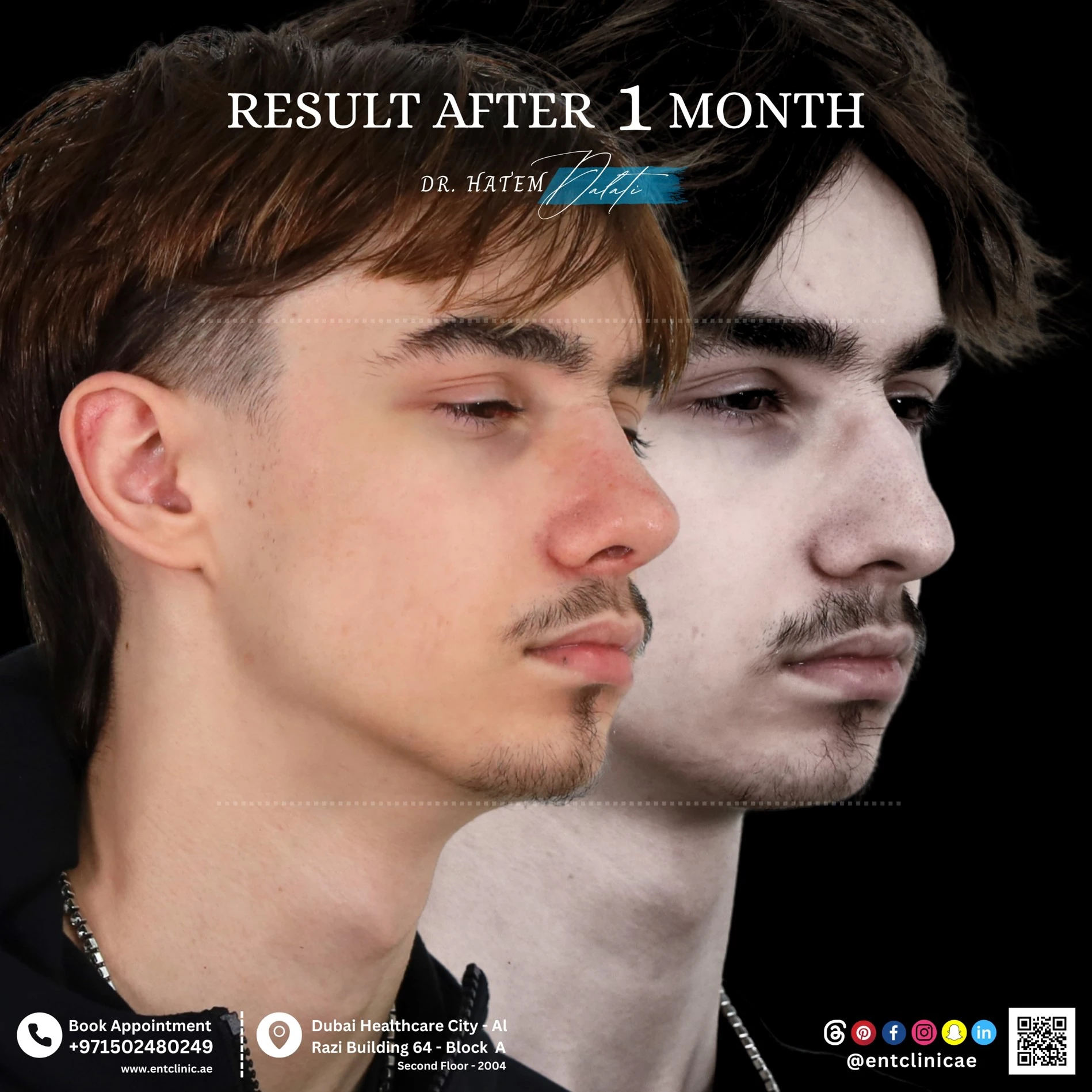 RHINOPLASTY-DR-HATEM-DALATI-DUBAI-ENT-CONSULTANT-ENT-CLINIC-OF-EXCELLENCE rhino (1)