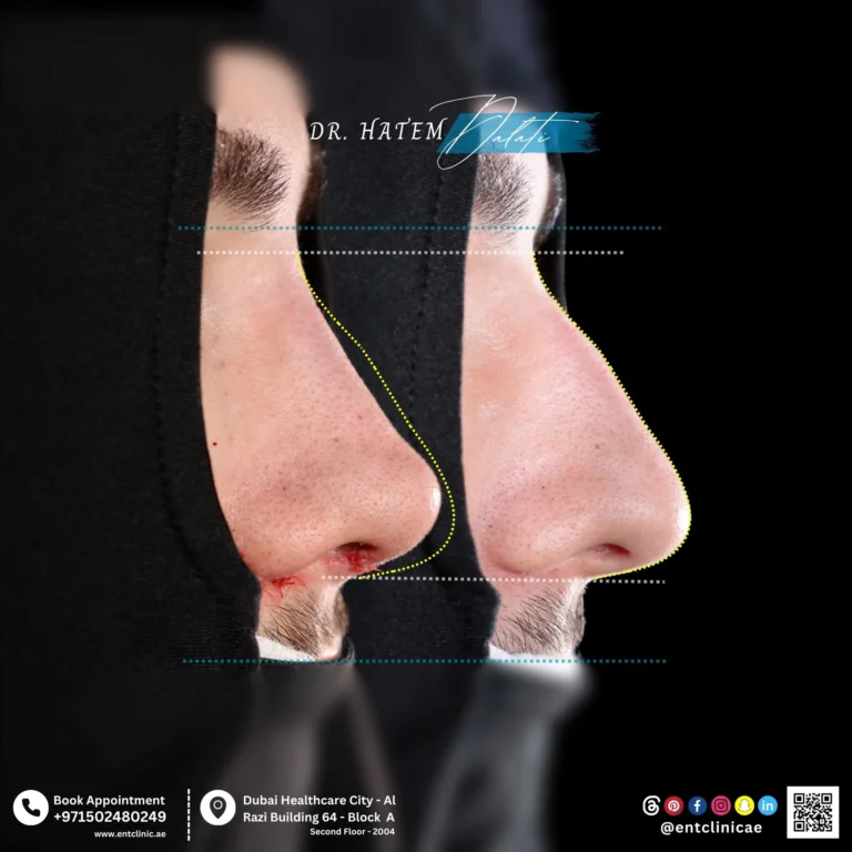 RHINOPLASTY-DR-HATEM-DALATI-DUBAI-ENT-CONSULTANT-ENT-CLINIC-OF-EXCELLENCE rhino (2)