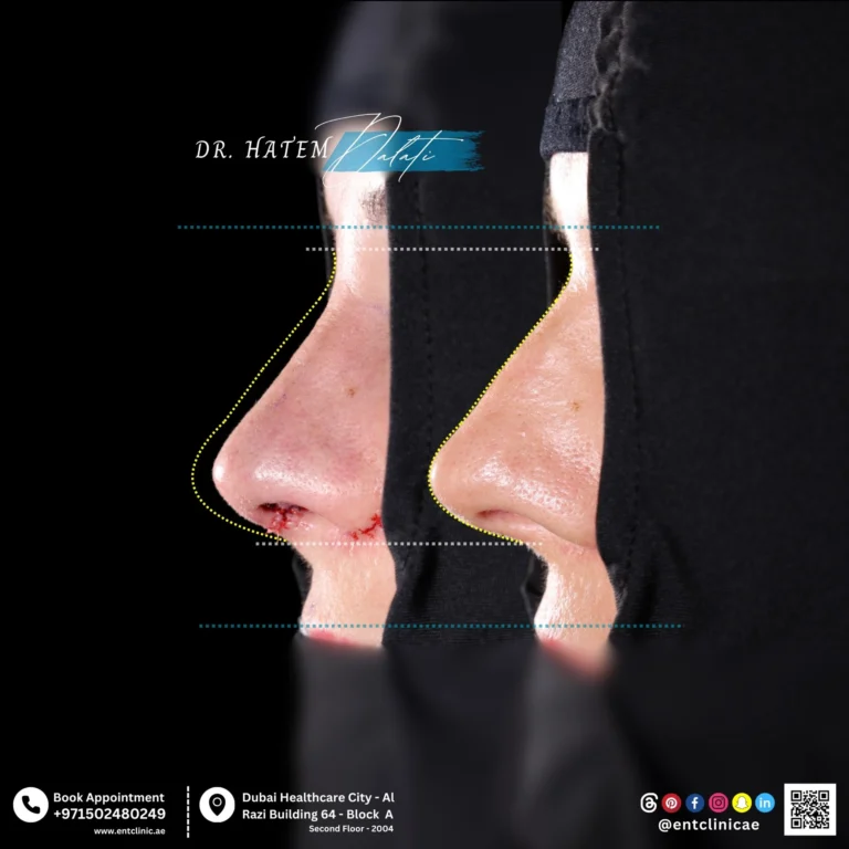 RHINOPLASTY-DR-HATEM-DALATI-DUBAI-ENT-CONSULTANT-ENT-CLINIC-OF-EXCELLENCE rhino (3)