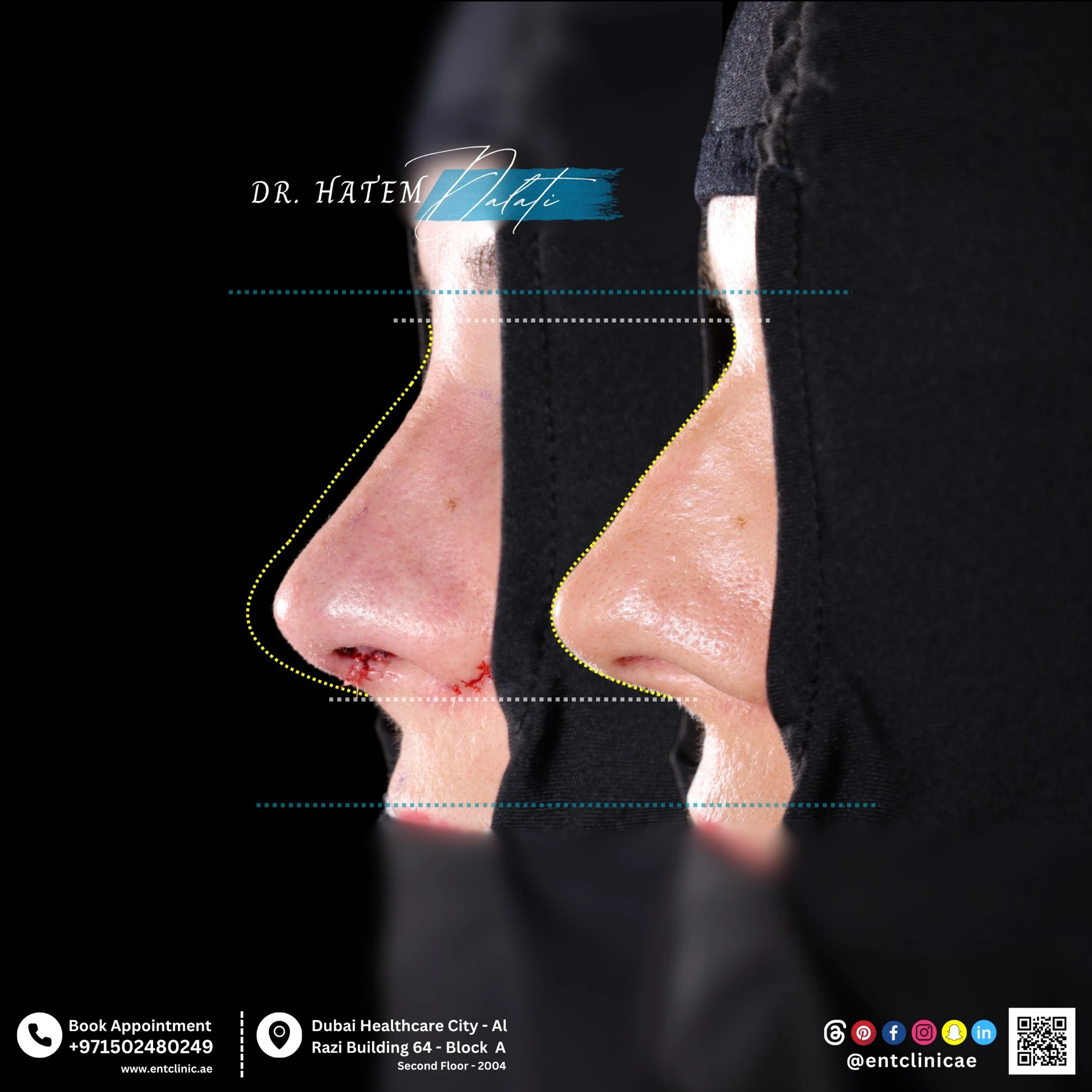 RHINOPLASTY-DR-HATEM-DALATI-DUBAI-ENT-CONSULTANT-ENT-CLINIC-OF-EXCELLENCE rhino (3)