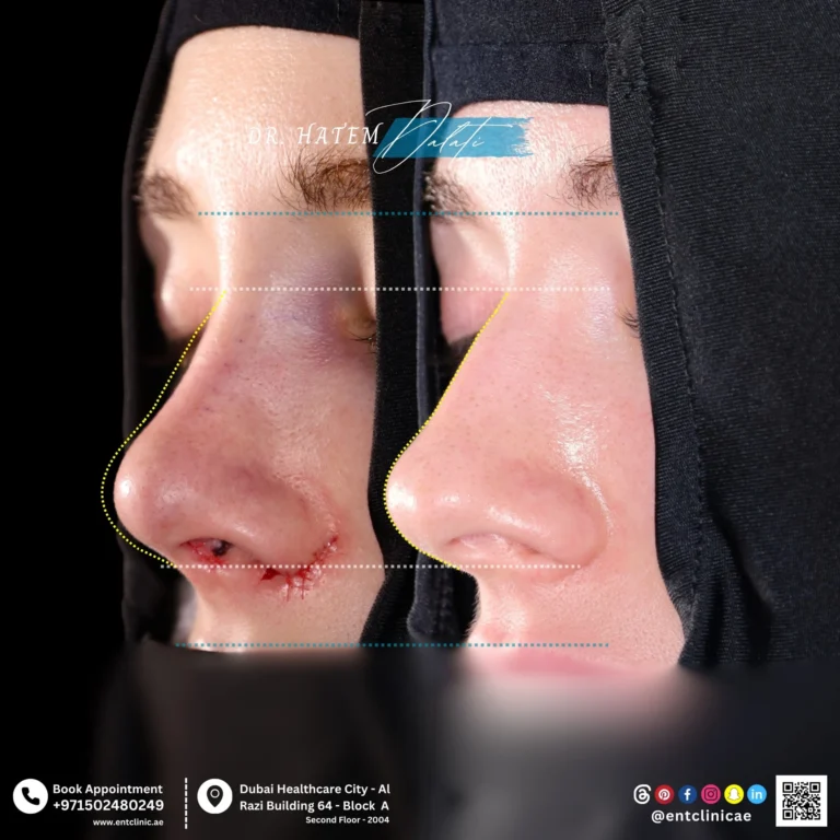 RHINOPLASTY-DR-HATEM-DALATI-DUBAI-ENT-CONSULTANT-ENT-CLINIC-OF-EXCELLENCE rhino (4)