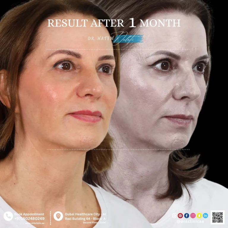 RHINOPLASTY-DR-HATEM-DALATI-DUBAI-ENT-CONSULTANT-ENT-CLINIC-OF-EXCELLENCE rhino (5)