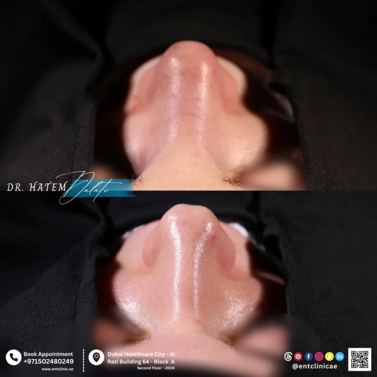RHINOPLASTY-DR-HATEM-DALATI-DUBAI-ENT-CONSULTANT-ENT-CLINIC-OF-EXCELLENCE rhino (6)