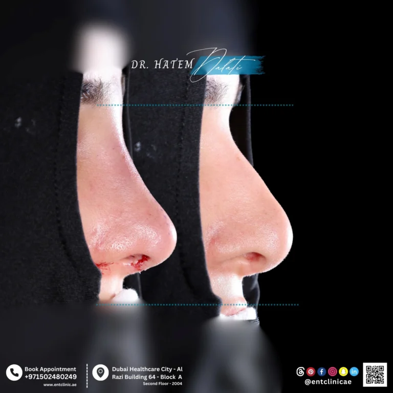 RHINOPLASTY-DR-HATEM-DALATI-DUBAI-ENT-CONSULTANT-ENT-CLINIC-OF-EXCELLENCE rhino (8)