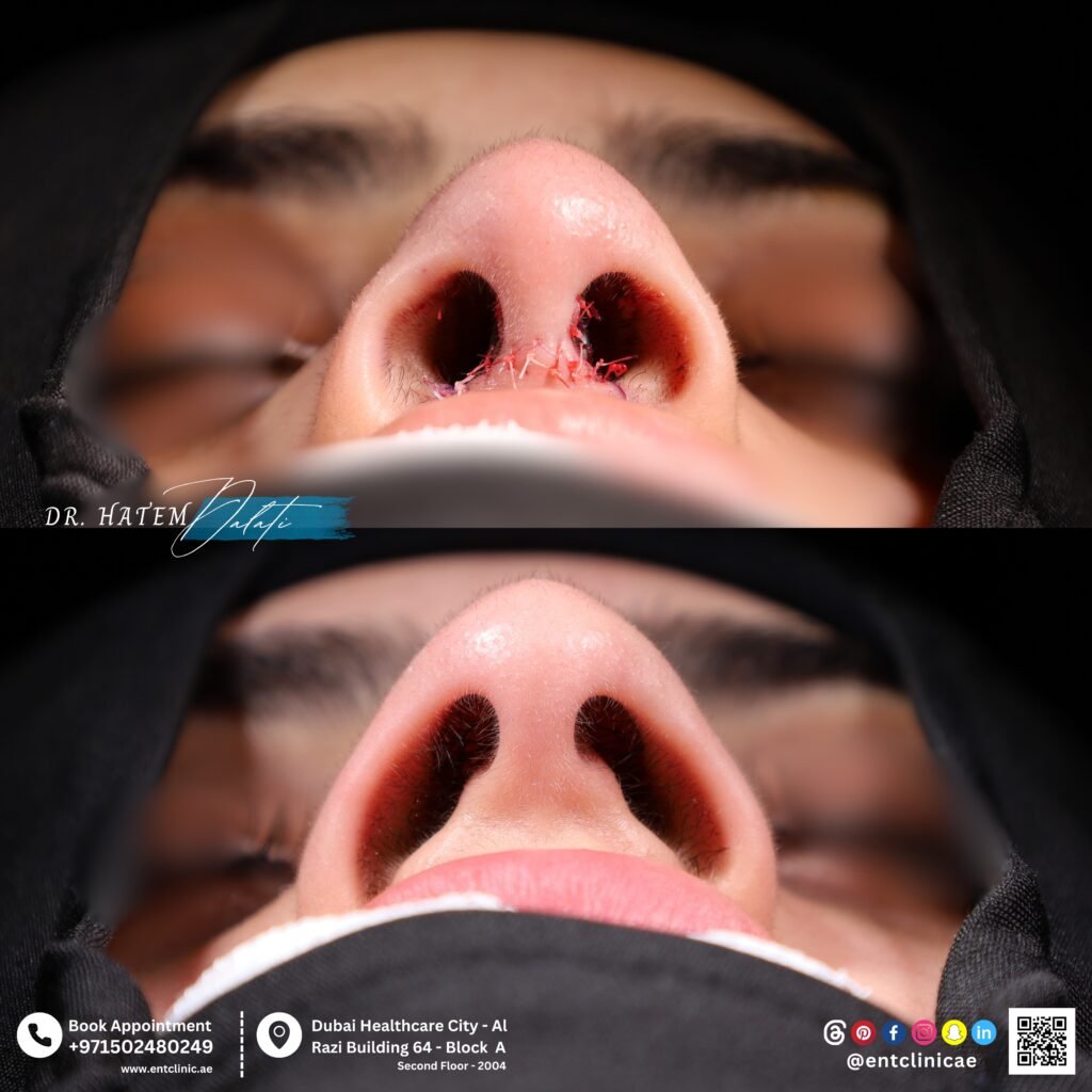 Wide nose rhinoplasty patient before and after showing nasal base and nostril proportions