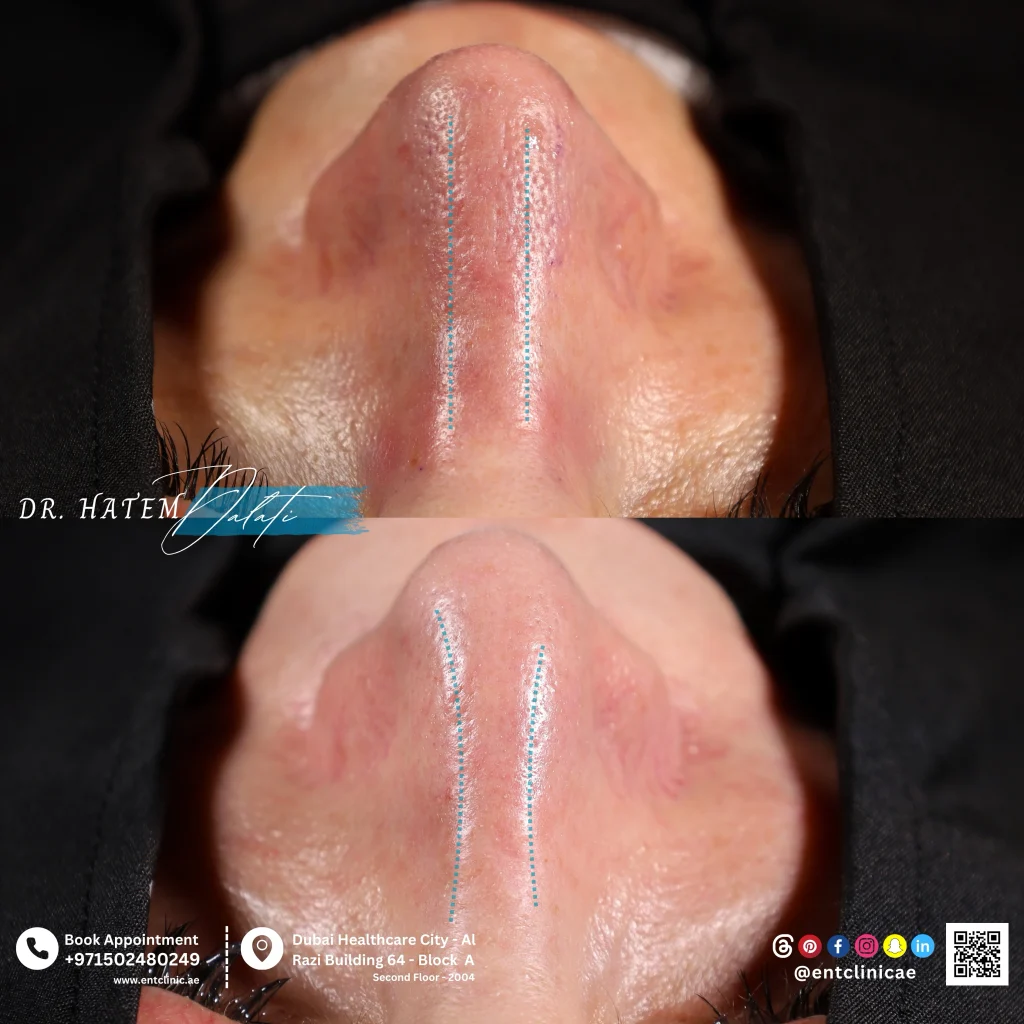 before and after dorsal view revision rhinoplasty for polybeak deformity