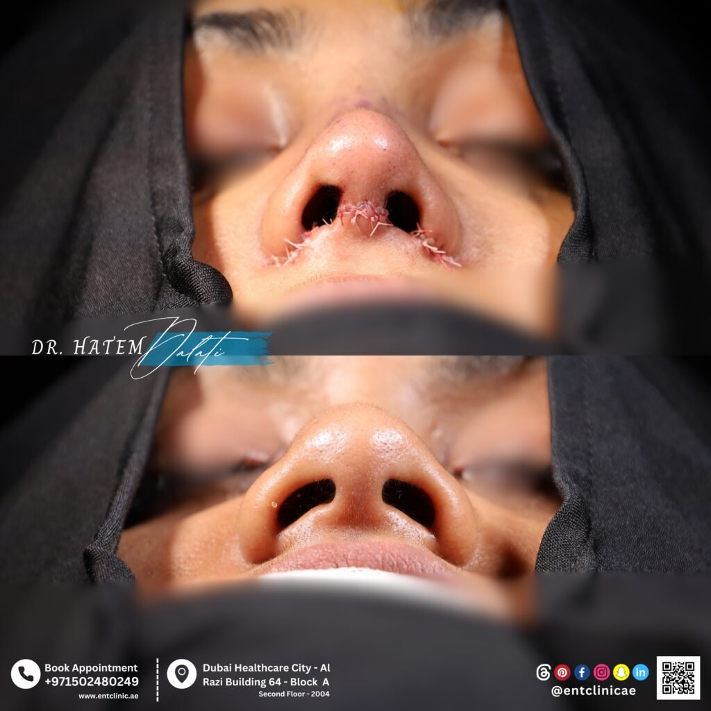 Wide nose rhinoplasty before and after basal view showing changes in nostril and nasal base width