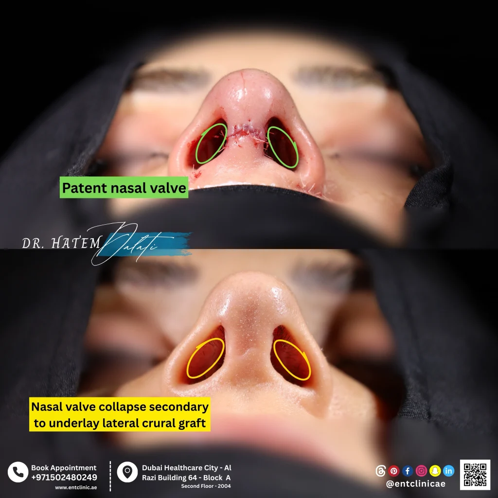 before and after photo functional revision rhinoplasty 