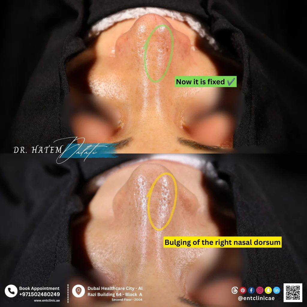 before and after photo functional revision rhinoplasty 
