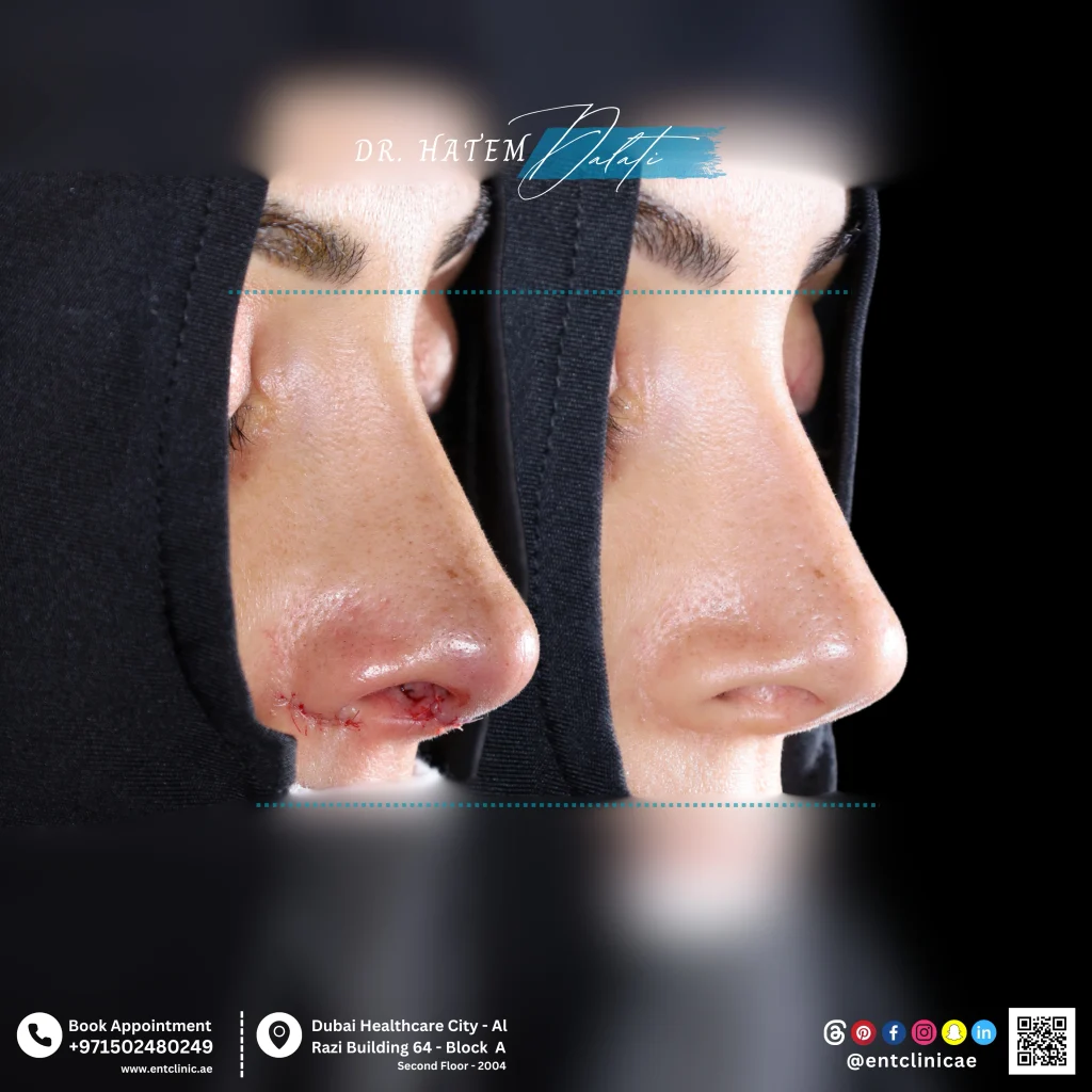before and after photo functional revision rhinoplasty 