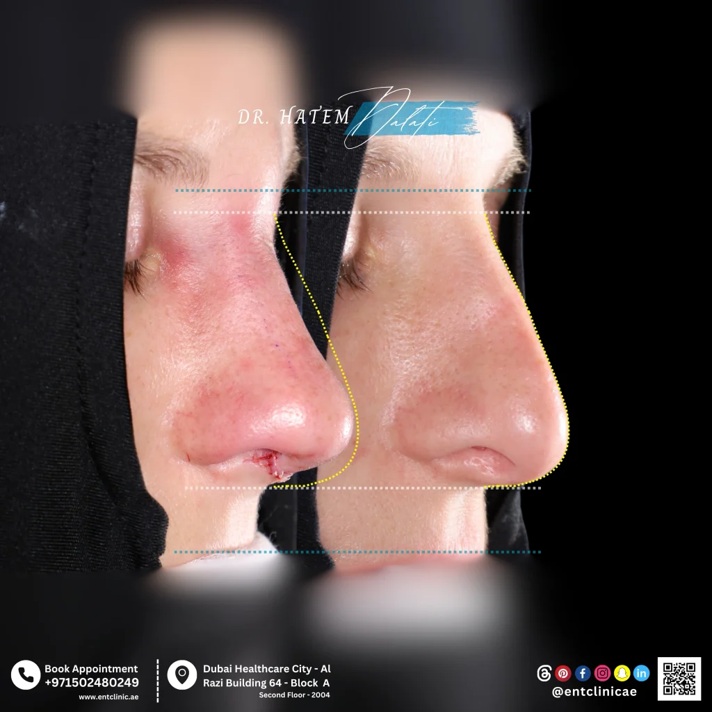 revision rhinoplasty before and after photo