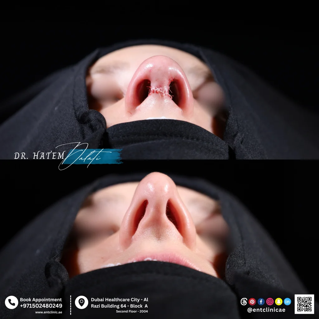 revision rhinoplasty before and after photo

