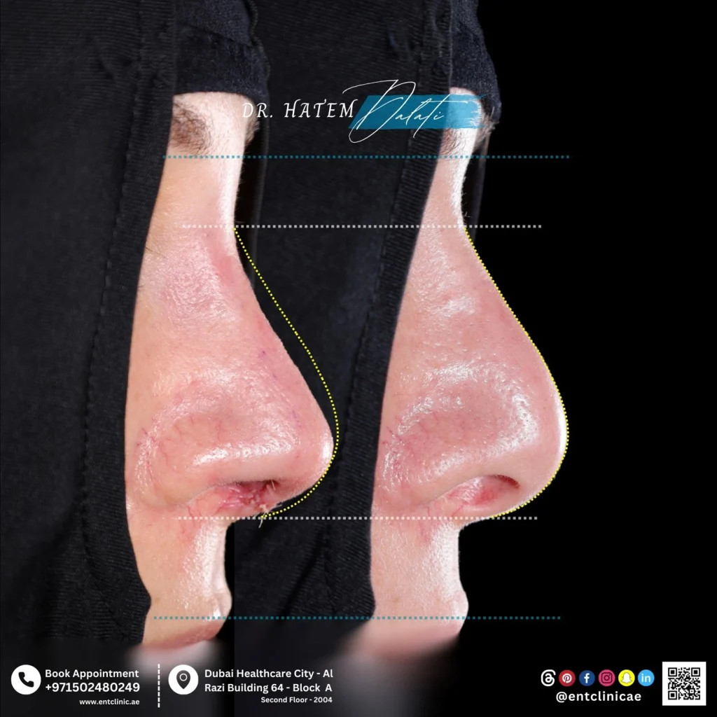 صورة قبل وبعد لعملية تجميل الأنف التصحيحية من الجانب لعلاج تشوه أنف المنقار