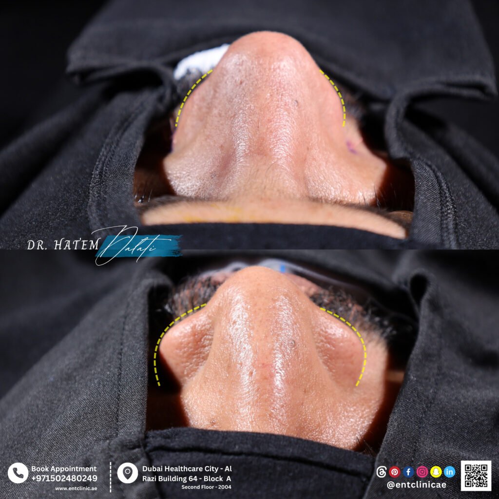 Before and after basal view following rhinoplasty for a wide nose