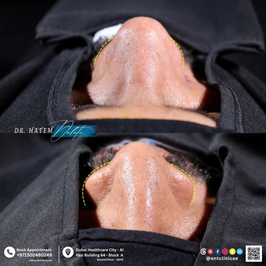 صور قبل وبعد توضح تضييق الأنف العريض وتحسين تناسق وشكل الأنف بعد عملية تجميل الأنف