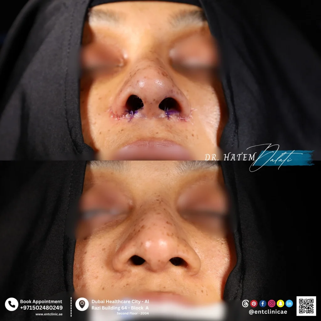 صور من المنظر السفلي قبل وبعد توضح تضييق وإعادة تشكيل الأنف بعد عملية تجميل الأنف العريض