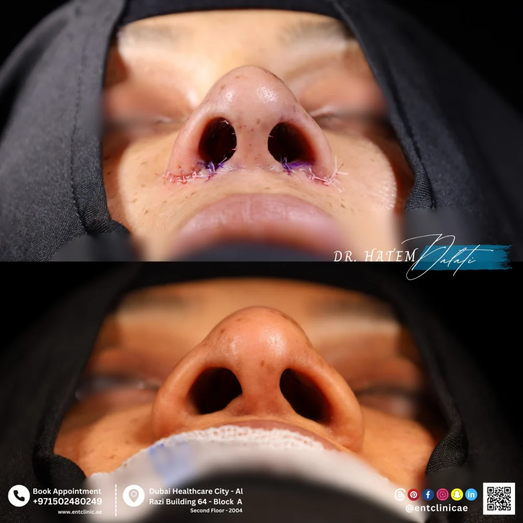 صور قبل وبعد لعملية تجميل الأنف العريض توضح تضييق الأنف وتحسين شكل طرف الأنف وقاعدة الأنف وتناسقها مع الوجه لدى د. حاتم دالاتي في عيادة التميز للأذن والأنف والحنجرة في دبي