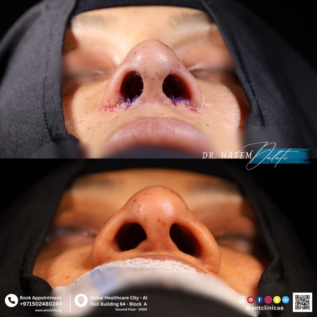 Wide nose rhinoplasty before and after basal view showing improved nasal base proportions