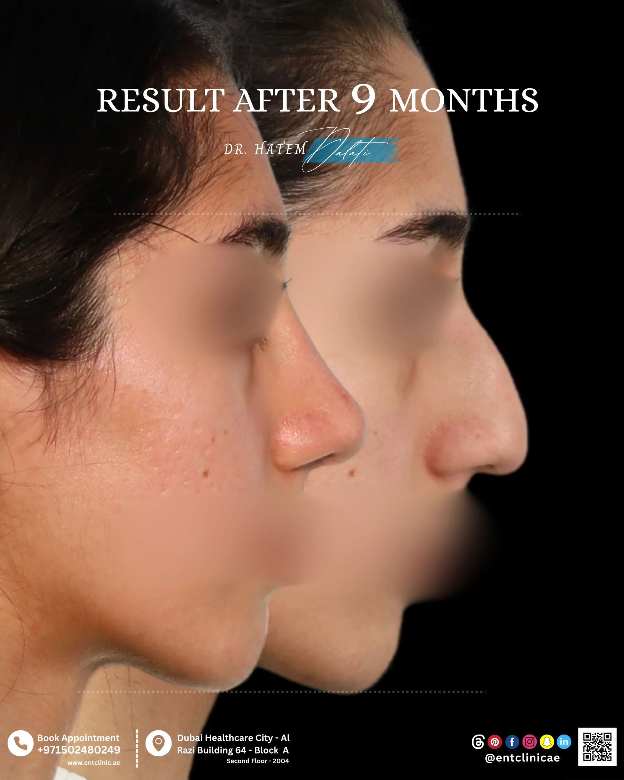 Patient side profile before and 9 months after functional and cosmetic rhinoplasty showing a natural and balanced nasal result