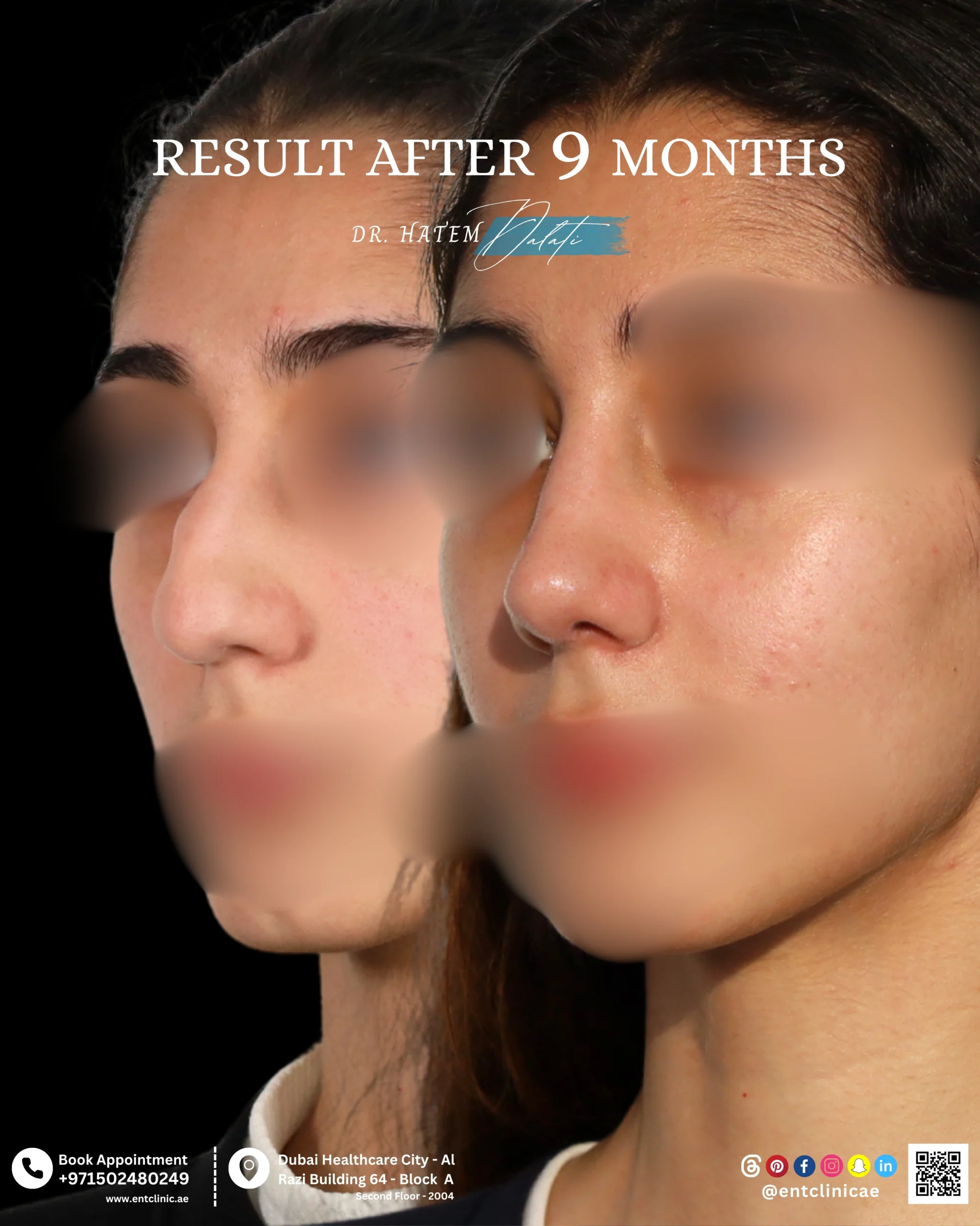 Patient before and 9 months after functional and cosmetic rhinoplasty showing a natural and balanced nasal result in three quarter view