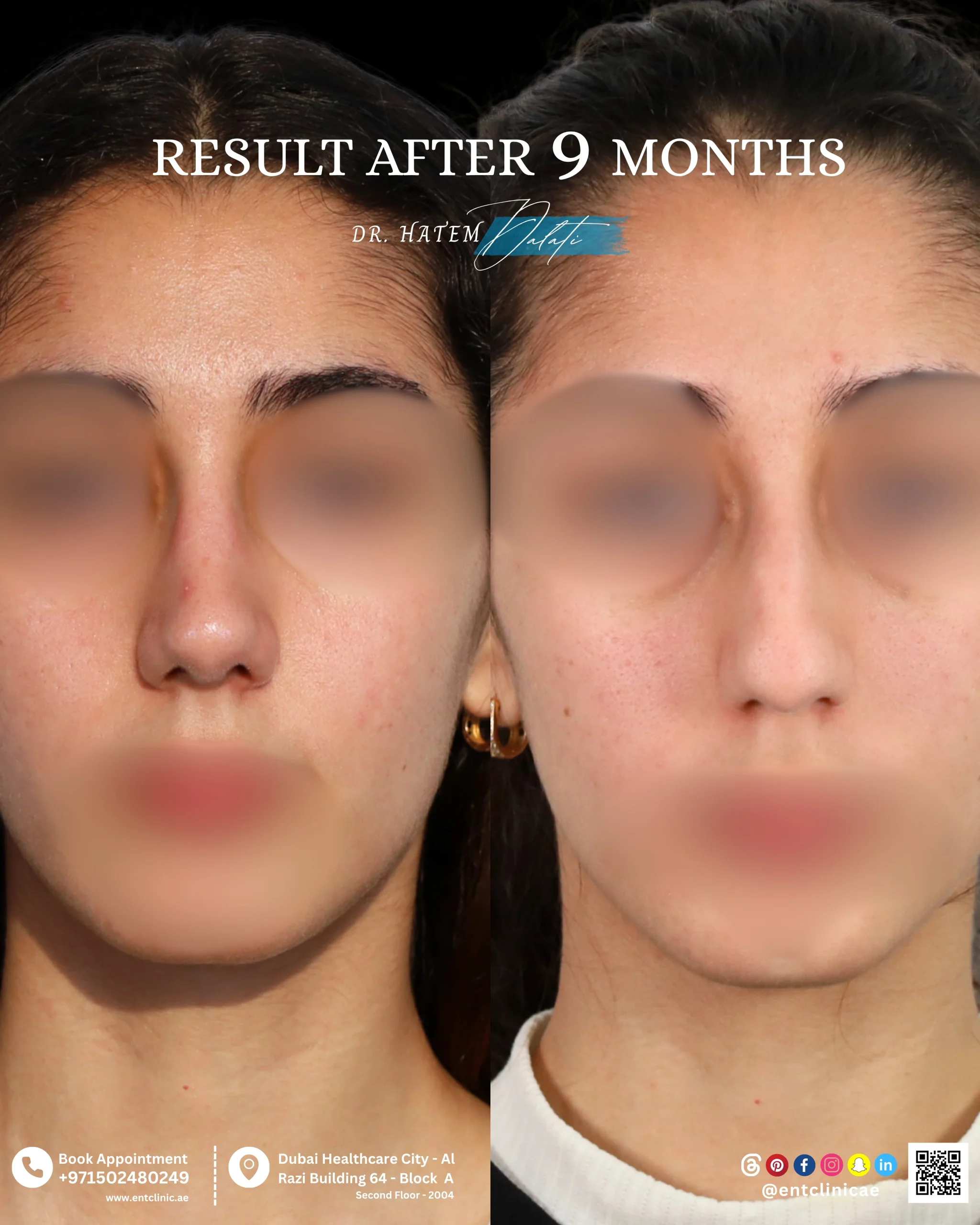 Patient front profile before and 9 months after functional and cosmetic rhinoplasty showing a natural and balanced nasal result