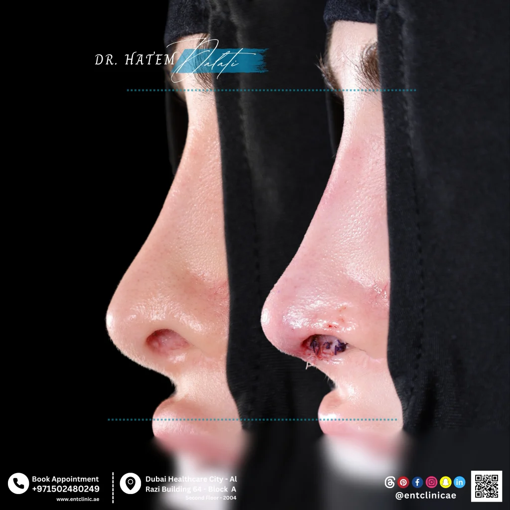 تشوّه على شكل حرف S في ظهر الأنف، وطرف أنف غير منتظم ومدبب، وتدلّي في العمود الأنفي، وتَقصُّر/انبعاج في الحافة السفلية اليسرى لجناح الأنف، بالإضافة إلى احتقان في الغشاء المخاطي للأنف بعد عملية تجميل أنف سابقة.
