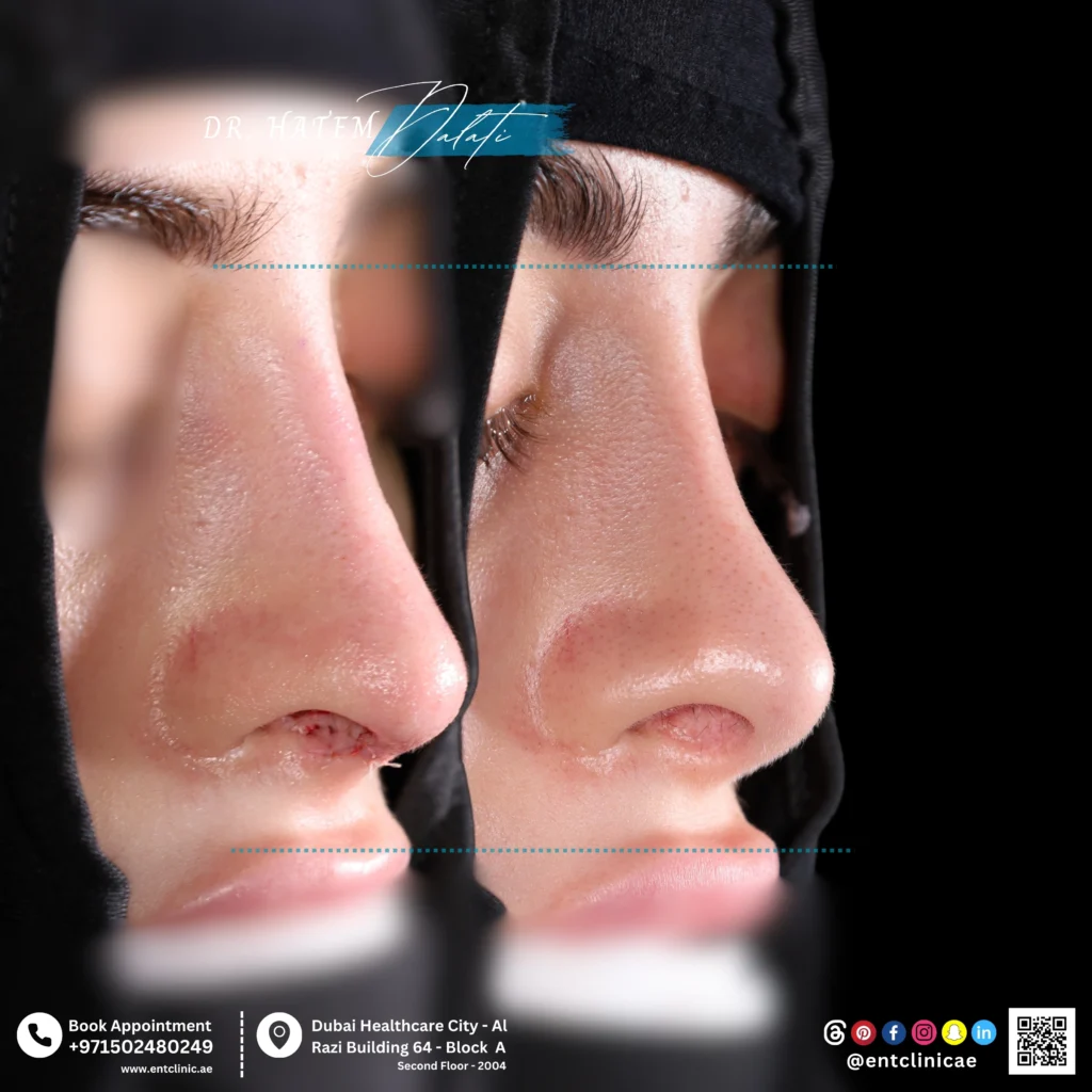 عملية تجميل أنف تصحيحية للمرة الثالثة بهدف معالجة تشوّه الأنف، وعدم انتظام طرف الأنف، وتحقيق التوازن البنيوي العام للأنف.