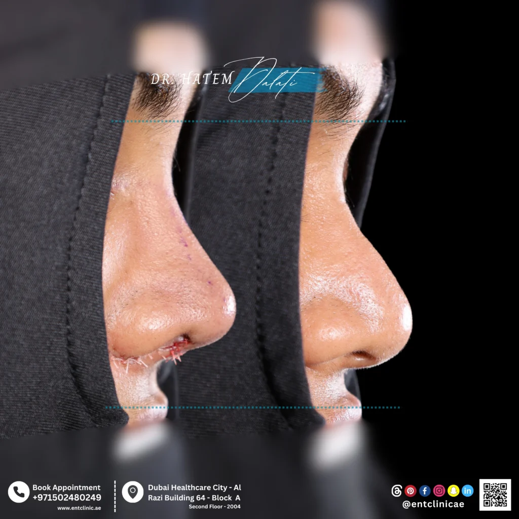 Side profile before and after primary septorhinoplasty with cartilage grafting