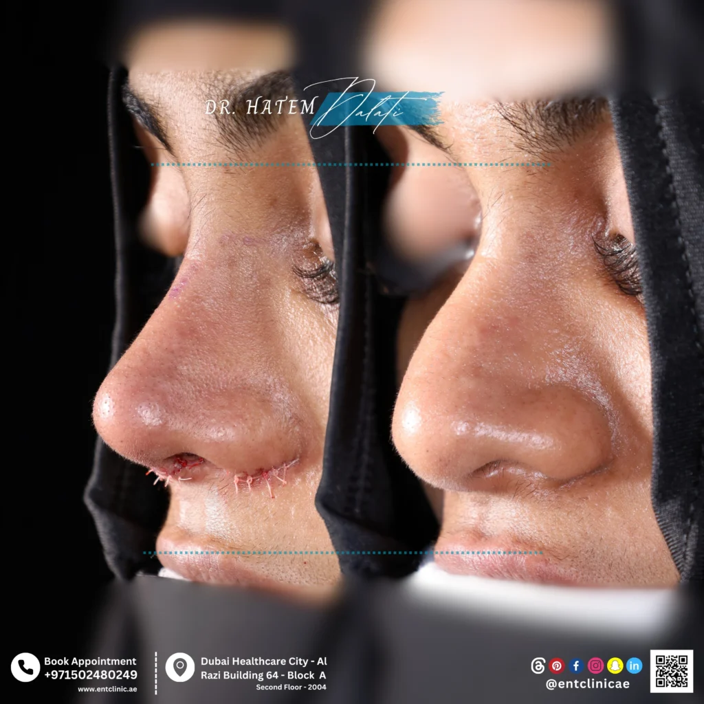 Three-quarter view before and after primary septorhinoplasty showing improved nasal symmetry, tip contour, and overall nasal structure
