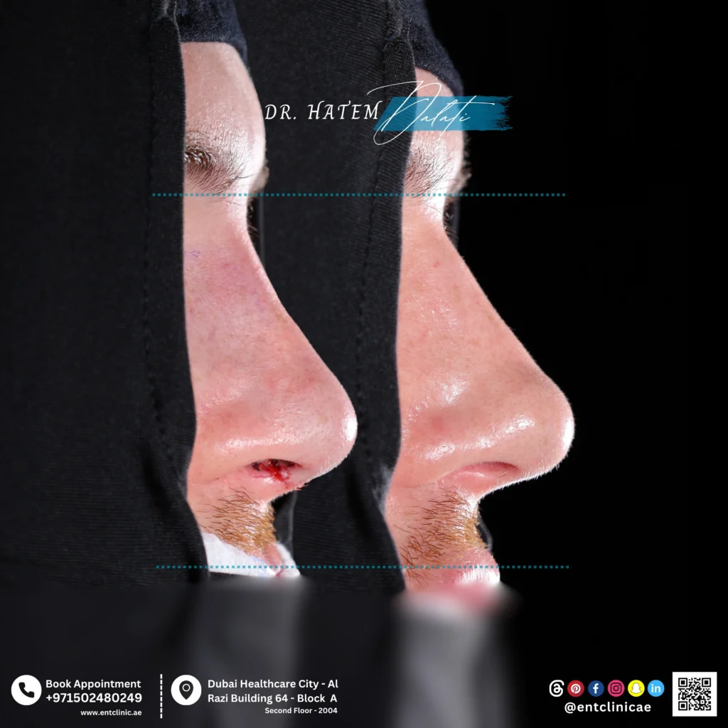 Before and after primary male septorhinoplasty showing natural nasal reshaping in profile view