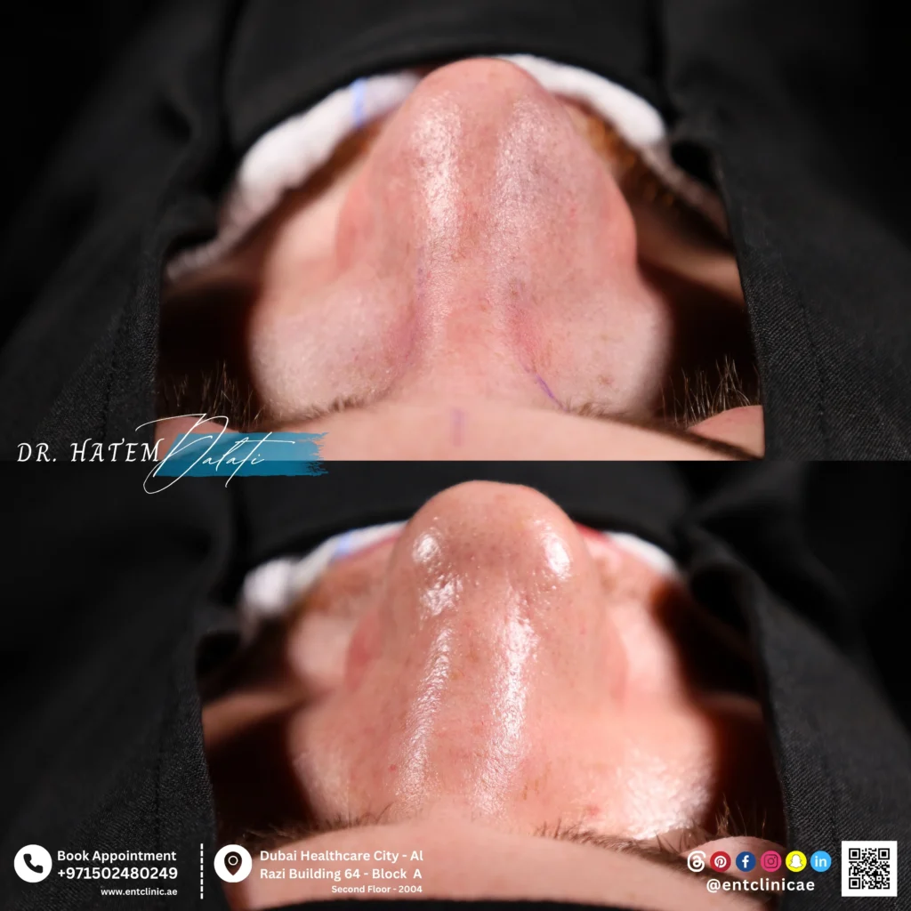Before and after primary male septorhinoplasty showing natural nasal reshaping septal view