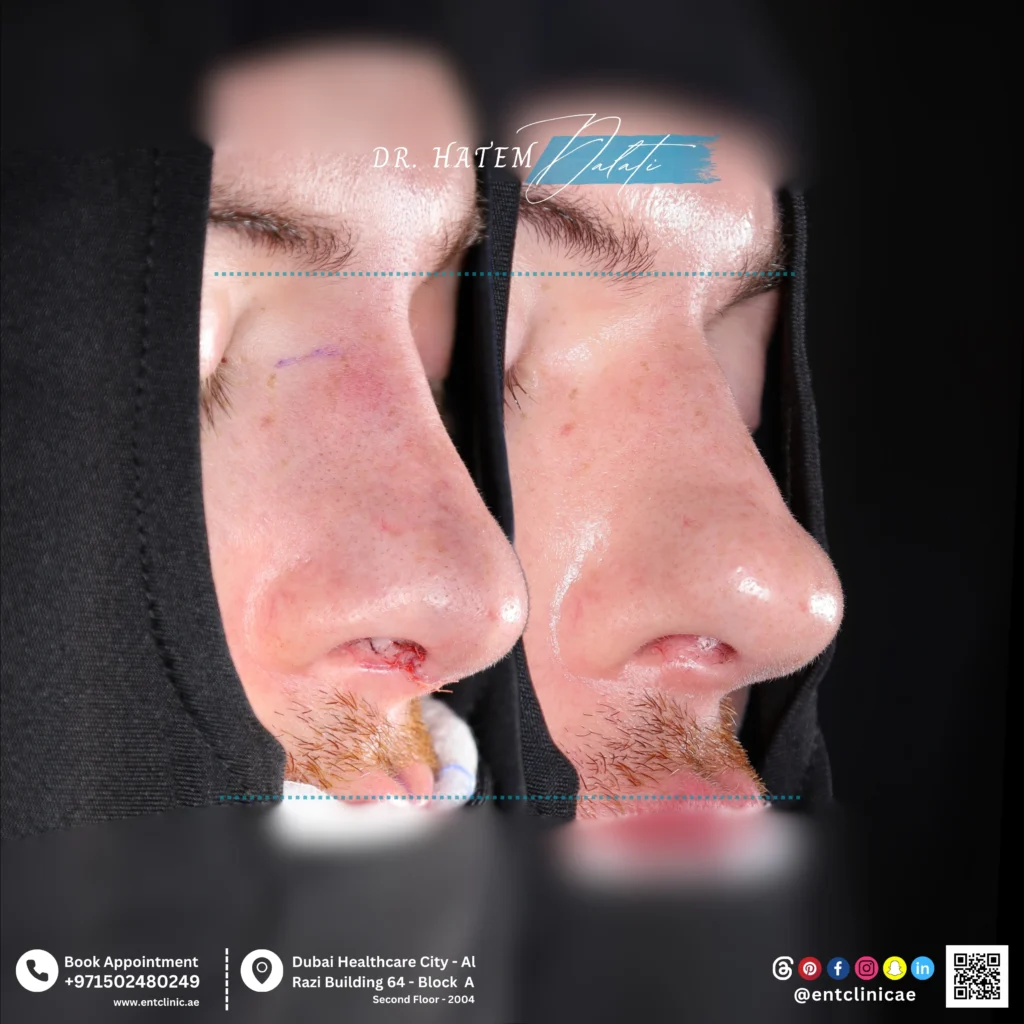 Before and after primary male septorhinoplasty showing natural nasal reshaping in three quarter view