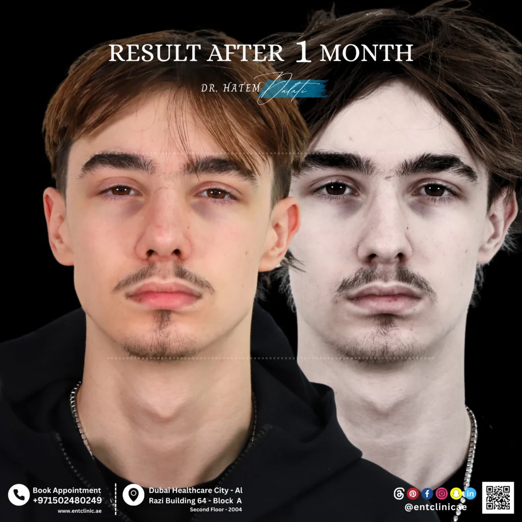 Rhinoplasty patient front view before and 1 month after rhinoplasty showing natural nose refinement