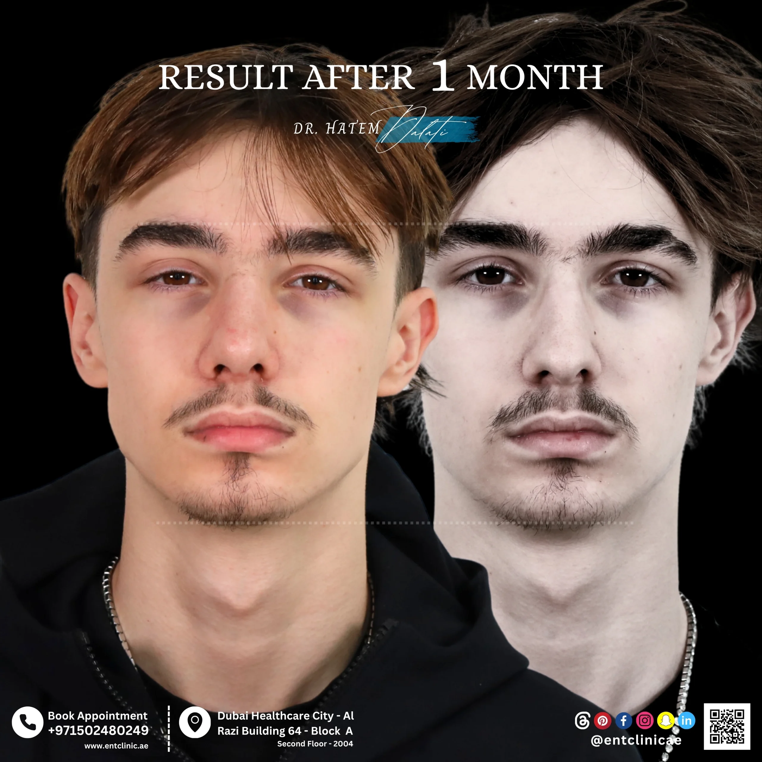 Rhinoplasty patient front view before and 1 month after rhinoplasty showing natural nose refinement