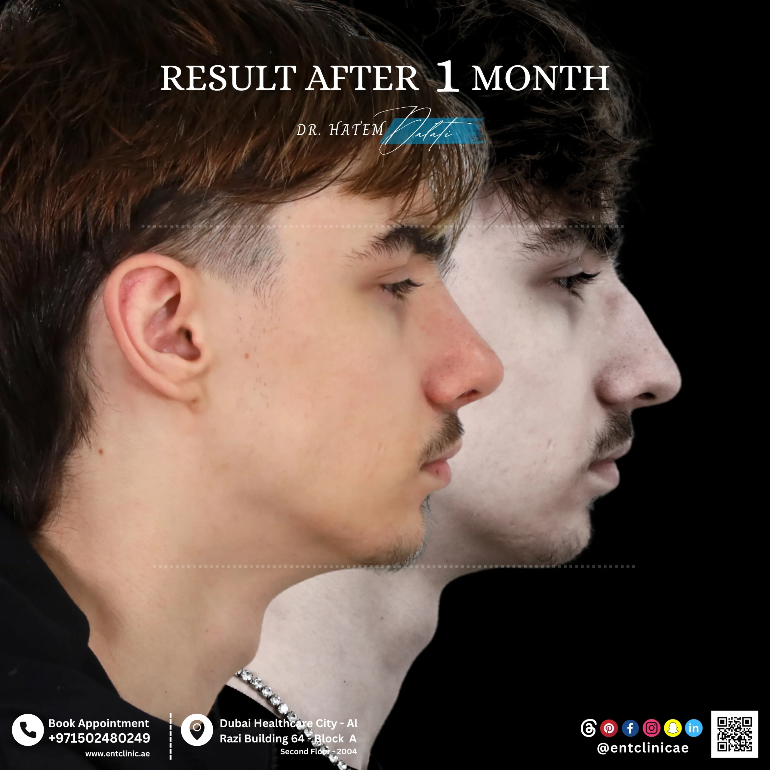 Rhinoplasty patient profile view before and 1 month after rhinoplasty showing natural nose refinement