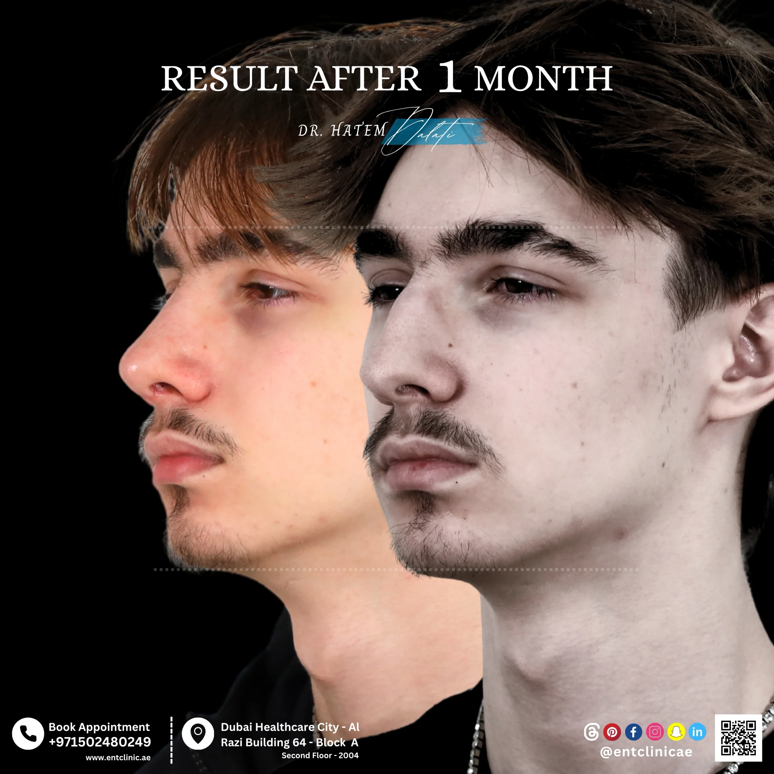 Rhinoplasty patient before and 1 month after rhinoplasty showing natural nose refinement in three quarter view