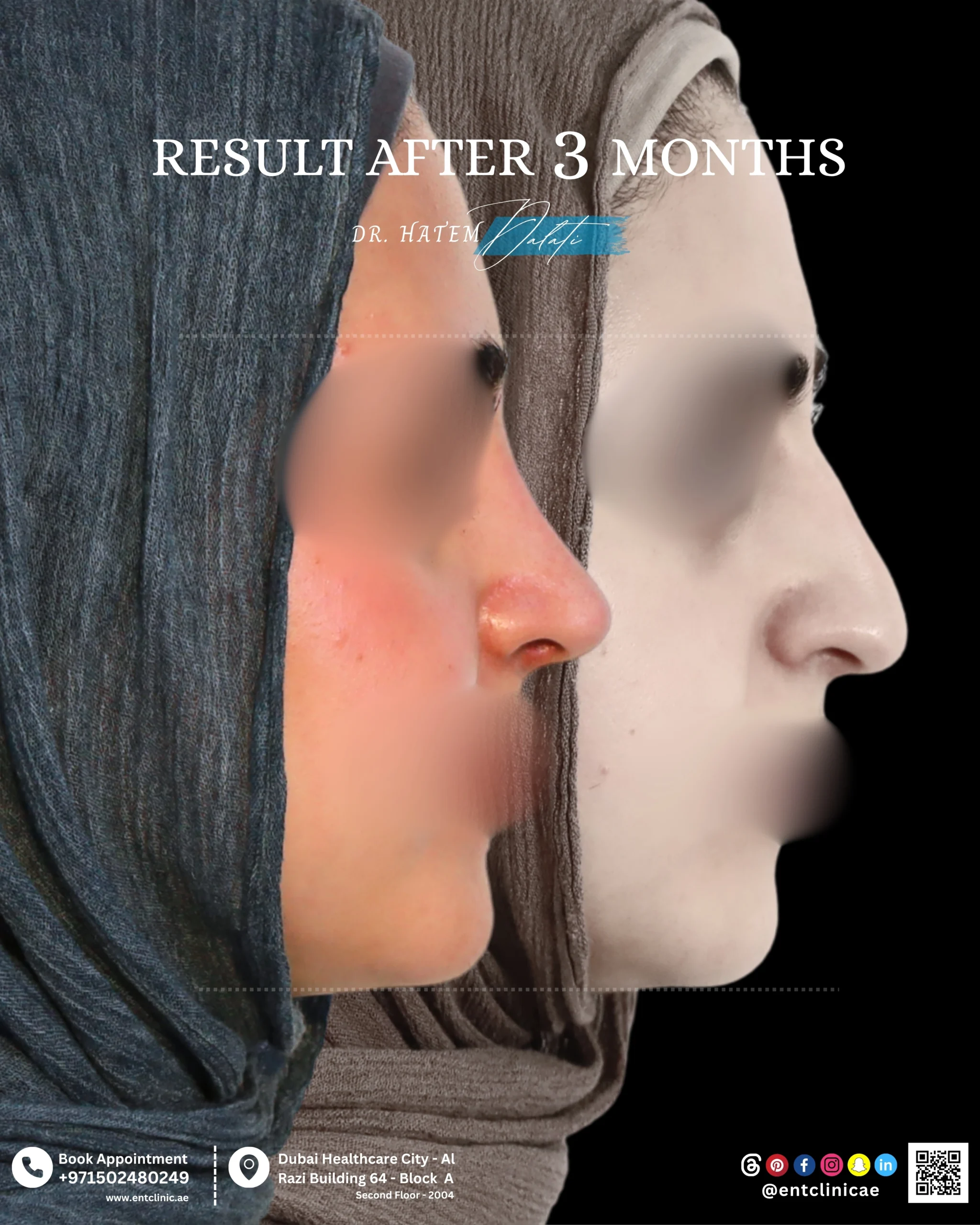 Patient side profile before and after 3 months rhinoplasty showing a refined and balanced nasal profile